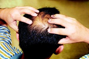 調查發現，七成男性相當在意髮量多少，但真正碰到禿頭問題時，卻有逾半數不知應至皮膚科就診。（聯合報系資料照片）