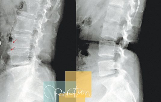 Ｘ光下，可清楚看出右圖是健康的脊椎，左圖已出現骨質增生的現象。