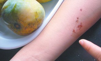 摘芒果被樹枝汁液濺到，皮膚因過敏而長水泡，醫師提醒有過敏體質者要小心。（記者劉惠敏／攝影）