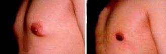 比較男性女乳症術前(左)及術後(右)的影像，可看出胸部明顯縮小。（賴永隆／提供）