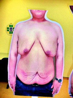 30歲吳姓男子快速減肥，造成全身皮膚鬆垮、胸部下垂。（記者苗君平／攝影）