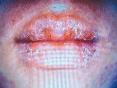 一名男大學生因舔唇、咬唇等不當習慣，導致嘴唇發炎，進食困難。（記者胡宗鳳／攝影）