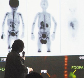 臺大核醫部主任曾凱元昨解說神經母細胞瘤診斷新進展，影像黑體處，即腫瘤細胞擴散部位。（記者侯永全／攝影）