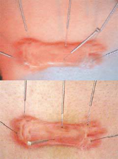 (上圖)蟹足腫疤痕，治療前會紅腫癢，顏色粉紅，隆起部位較為突出。(下圖)針灸治療後，紅腫痛消退，顏色變淡，隆起部位也變得較為平整。（圖片／北醫附醫提供）
