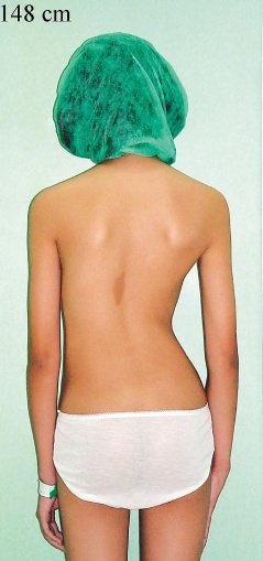 十六歲少女因脊椎側彎近六十度，左右側臀部明顯不對稱，造成屁股一大一小。（圖／沈文哲醫師提供）