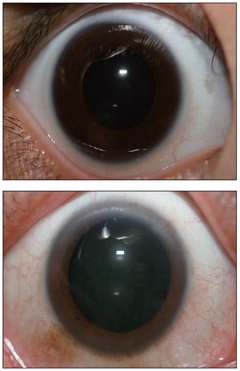 黑眼球外出現色素沉著（下圖）？可能是身體警訊。  照片╱吳仁斌醫師提供