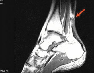 患者足部Ｘ光片，箭頭顯示為阿基里斯腱斷裂處。 圖／卓裕森提供