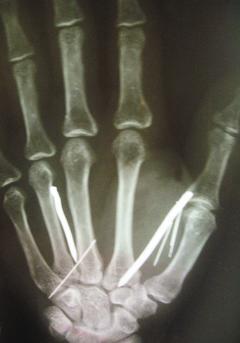 X光照片顯示，斯里蘭卡女傭艾里雅瓦蒂手部被釘入鐵釘。 （路透）