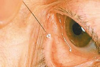 醫師可將「淚管塞」置入患者下淚孔，增加淚水滋潤眼球時間，減少藥水流入鼻腔機會。 圖／陳祐瑲醫師提供