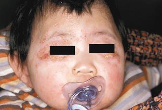 嬰幼兒異位性皮膚炎為一種「奶癬」。 圖／林仲醫師提供