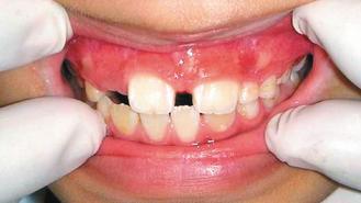 上顎恆門牙不但牙齒大，牙縫也大。
圖／李國慶醫師提供