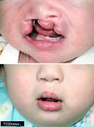 唇顎裂兒童治療前與治療後判若兩人。（記者周志祥攝）
