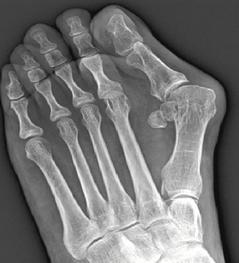 大腳趾外翻，X光片下可見第一蹠骨的角度明顯向外傾斜。 照片提供／江昭慶醫師