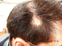 28歲陳先生兩年前頭部出現「圓禿」；經治療後，禿髮處已重新長出頭髮。