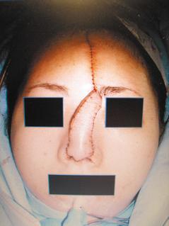女子鼻頭被狗咬掉，手術將額頭皮瓣覆蓋到鼻頭後，長出血管切除皮瓣，再多次整形恢復容貌。 記者修瑞瑩／翻攝