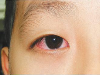 結膜炎與淚管炎都會眼睛紅，結膜炎在眼睛內外上下側皆會紅眼，具傳染性。 圖／蔡傑智醫師提供