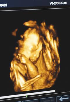 透過立體超音波，準爸媽能搶先一步，看到腹中胎兒五觀外型、生殖器等。但婦產科醫學會直言，這檢查只是噱頭。圖為4D超音波影像。 圖／本報資料照片