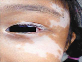 吳同學因白斑症，出現白眼圈。 圖／曾興隆醫師提供非報系