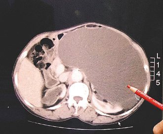 電腦斷層顯示婦人有三個腎，陰影大的是水腫的腎。 記者陳秋雲／翻攝