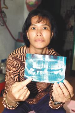 郭冬妹出示右下臼齒的人工牙根X光片，質疑牙醫未診斷她是否適合植牙，造成她痛了2年。 記者楊德宜／攝影