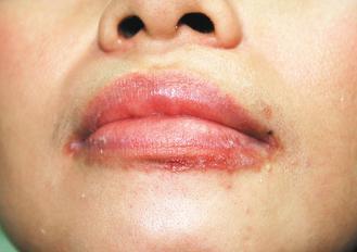一名女性把含類固醇成分的藥膏當護唇膏，擦到嘴唇周圍紅腫，還冒出疹子。 圖／潘企岳提供