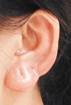 患者耳垂反覆發炎腫脹，拖了一年就醫，耳垂變硬、纖維化，無法再戴耳環。 圖／黃季怡醫師提供