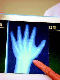 Ｘ光可檢測骨齡，醫師手指處顯示生長板尚未癒合。 記者張嘉芳／攝影