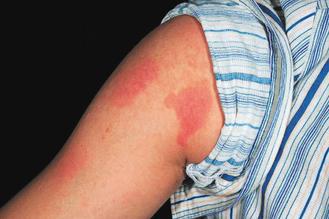 圖1:初起的植物光照性皮膚炎，皮膚出現灼痛紅斑。
圖／林仲醫師提供