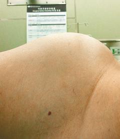 林小姐腹腔長了一個22公斤的巨大卵巢瘤，以致她的肚子比懷雙胞胎更大。 台北慈濟醫院/提供