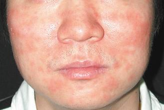酒糟性皮膚炎第一期，患者臉部潮紅，以頰部、鼻頭、額頭及下巴較明顯。 圖／澄清醫院提供