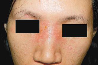 一名年輕女性戴眼鏡戴出接觸性皮膚炎，眼睛周圍皮膚發癢、泛紅，相當不舒服。 照片提供/台北國泰醫院