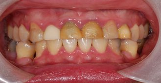 簡子傑術前不但有十多顆蛀牙，臨時裝的假牙也泛黃變色，還有牙周病第二期、牙齒排列不整齊等問題。（圖／吳權倫提供）

