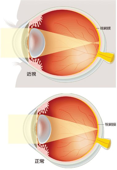 近視是指遠方影像，進入眼睛後，影像沒有正確的投
射在視網膜，反而投射在視網膜前方，使眼睛失焦，
看不清遠方影像。（圖／廖珮涵繪製）
