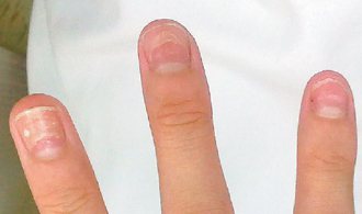 一病患在手足口症痊癒數周後，指甲剝落。 圖／葉勝雄醫師提供