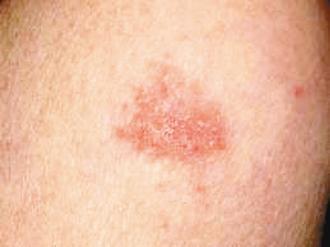 濕疹患部呈小紅丘疹，可能進展成水泡。圖／報系資料照