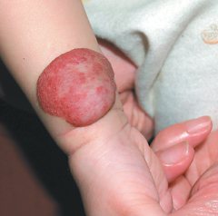 10月大女嬰的手臂上長出直徑達5公分的血管瘤，須定期注射類固醇藥物才能縮小。 圖／劉昭宏醫師提供