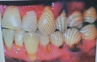 罹患修格連氏乾燥症患者因唾液分泌不足，通常有嚴重蛀牙及牙周病。 記者修瑞瑩／翻攝