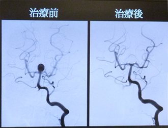 雙和醫院影像醫學部主任陳啟仁表示，患者經椎動脈血管攝影發現腦部有一個直徑1.4公分的基底動脈瘤（如圖左黑色圓圈處），治療後已看不到黑點。記者張祐齊／攝影