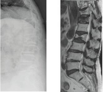 左圖是Ｘ光，右圖為MRI影像，箭頭所指是骨折部位，可看到正常的長方形骨，變形成了梯形骨。 圖／李企桓醫師提供