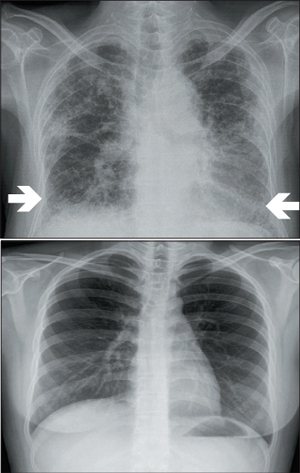 肺纖維化患者的肺臟，雙側下肺葉及肺的周邊出現網狀構造(上圖)，與正常肺的影像(下圖)明顯不同。 圖／趙志浩醫師提供