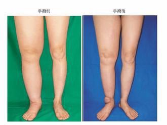 術前(左)術後(右)
林口長庚在患者腳踝移植頸部淋巴皮瓣，像是裝了抽水馬達，可消除水腫，手術成功率高達9成8。 鄭明輝醫師/提供