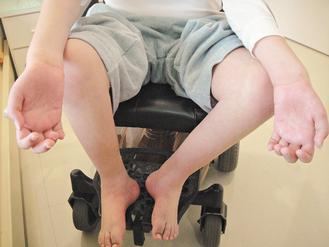 遺傳性運動感覺神經病變會造成患者手或腳肌肉萎縮。 圖／台北榮總提供