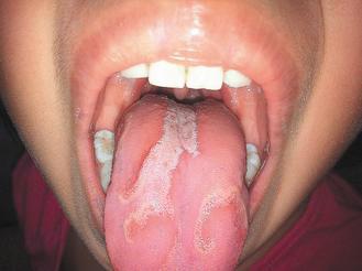 小朋友出現地圖舌和皮膚炎，可能是受到病毒感染，免疫力變差。 圖/書田診所提供(非報系)