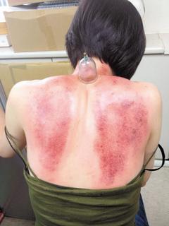 中醫師表示，刮痧散熱僅需刮出皮膚有小紅點即可，若太用力皮膚出現傷口，可能有感染風險。 記者邱瓊平/攝影