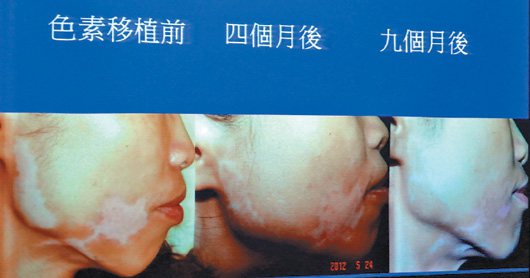 30歲女子使用美白保養品，卻在臉頰處造成永久性白斑（圖左），經過移植治療後，才逐漸恢復。 記者修瑞瑩／翻攝