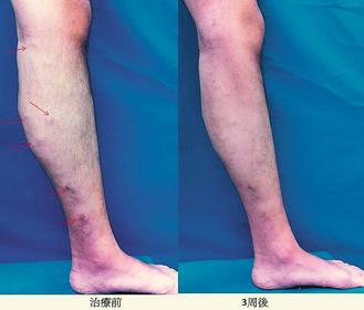王姓學生左小腿浮出蚯蚓狀靜脈曲張（左），經微創雷射靜脈閉合手術後3周（右）獲改善。 圖／醫師陳建彰提供