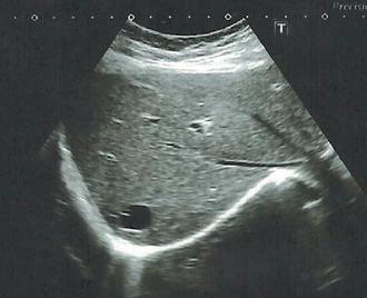 超音波影像可看到肝組織內有大小不一的肝囊腫。
圖／王世晞醫師提供

