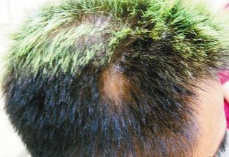從事美髮業務的型男長期重覆染髮，導致「圓禿」。 圖／張祺璋醫師提供