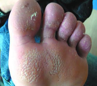 一名15歲男學生染上「小凹狀角質溶解症」，腳上出現如被蟲咬過的斑痕。 圖／書田診所提供