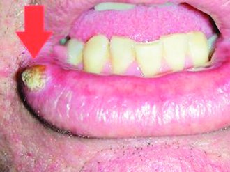 長在嘴角的口腔癌（圖非病患本人）。</br>
圖／醫師蘇家龍提供